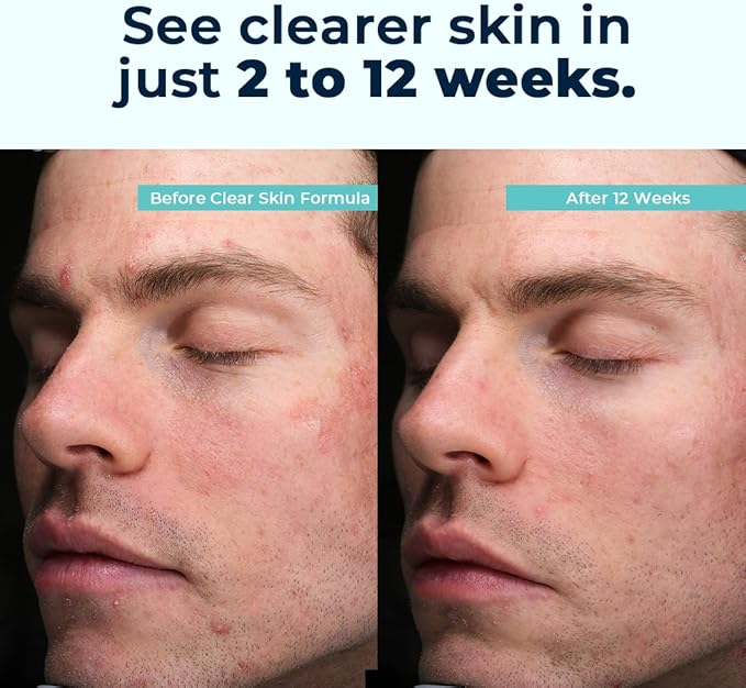 VitaMedica Clear Skin Vitamin Formula | Noncystic Acne Supplement for Skin Clearing | Breakout Treatment for Women and Men | Vitamins A, C, E, Selenium, Chromium, and Zinc for Skin Health | 2 Pack