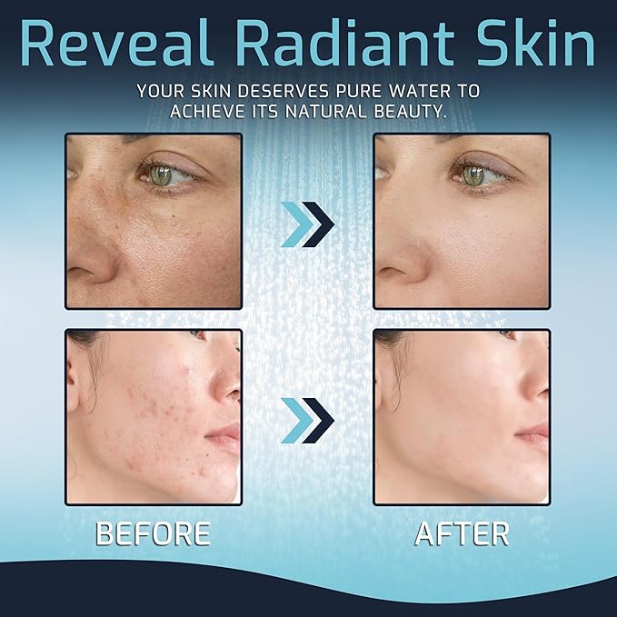 Mist Filtered Shower Head, Revitalizing 15 stage Shower Filter Combo, Improves The Condition of Your Skin & Hair, Shower Water Softener-High Output, Chrome, Compact - Shower filter for Hard Water