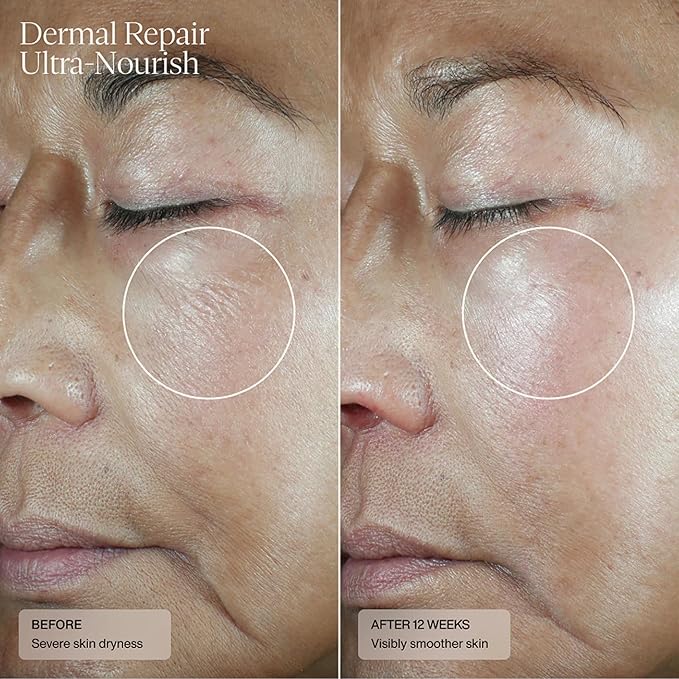 Senté Dermal Repair Ultra-Nourish - Rosacea Treatment For Dry, Sensitive Skin | Repairs, Replenishes & Reduces Skin Redness - 1.7 Fl Oz